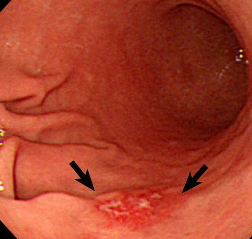 早期胃癌如何提防?都有哪些表现?